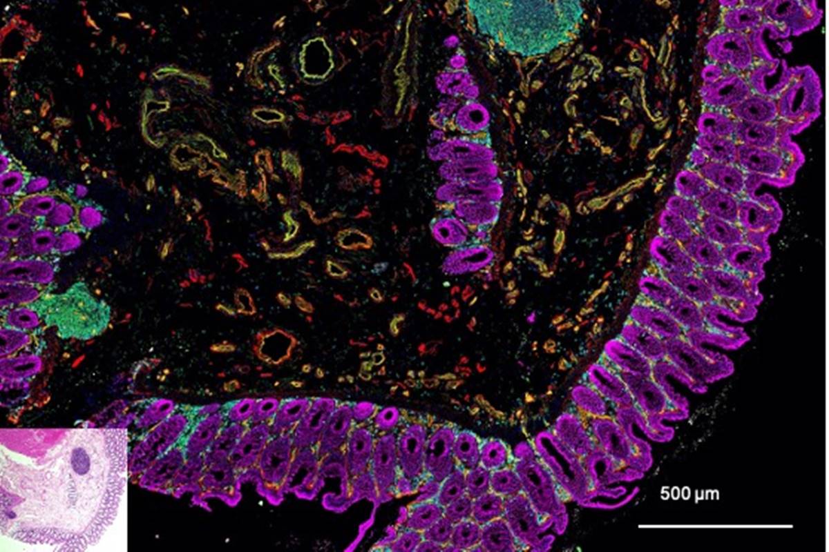 Estudo associa toxina de bactéria a câncer colorretal