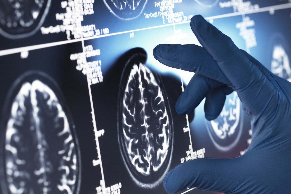 Alzheimer: estudo brasileiro acha marcador para acelerar o diagnóstico