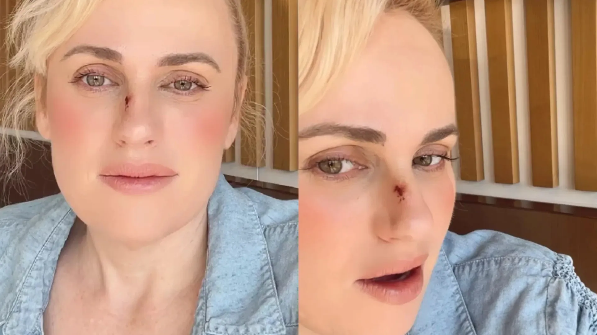 Rebel Wilson e o acidente no filme 'Bride Hard' que exigiu cirurgia