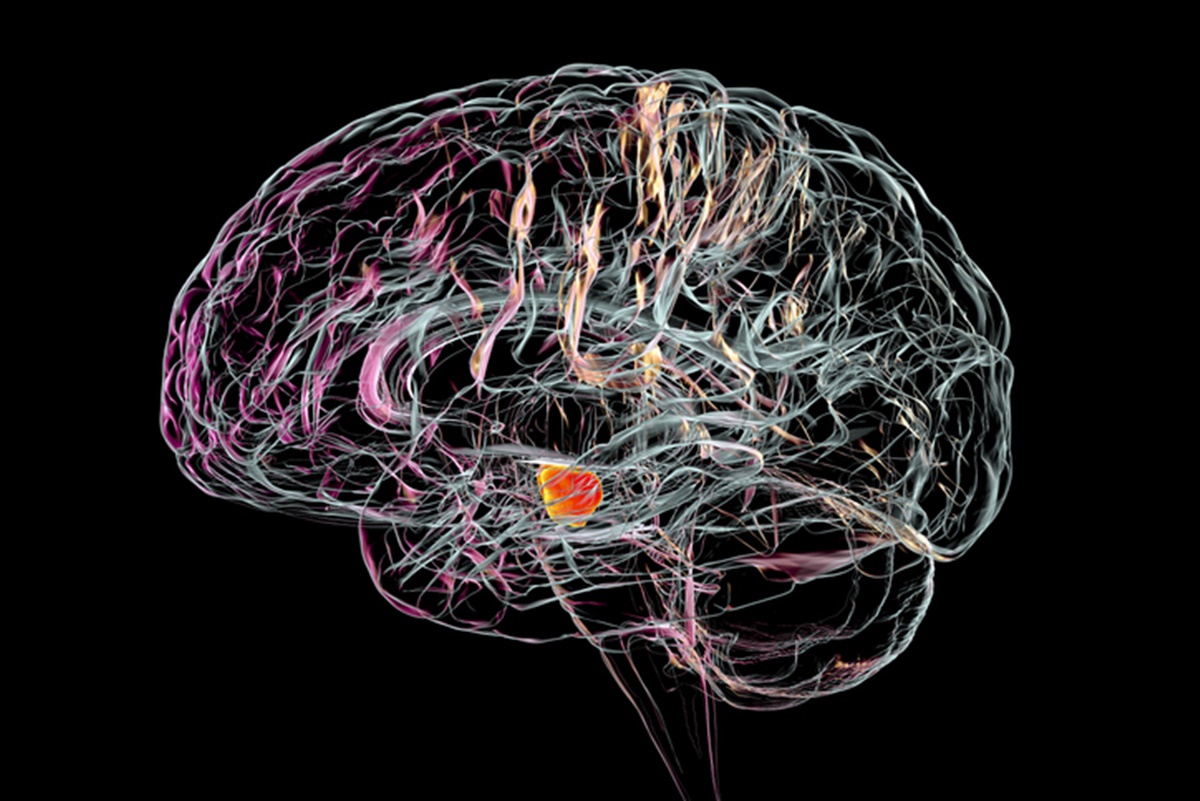 Acúmulo de açúcar nos neurônios pode agravar Alzheimer. Entenda