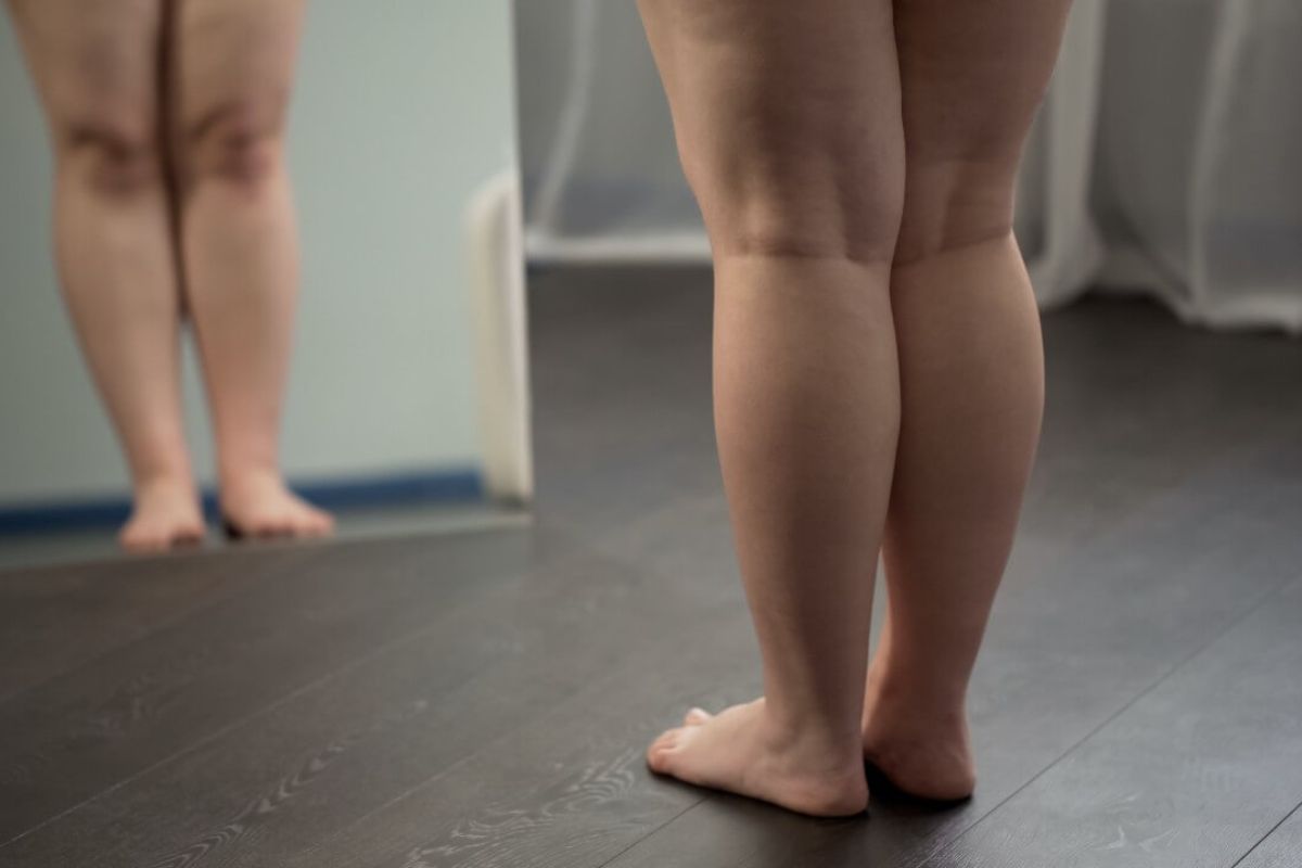 Nutricionista indica 3 dietas que auxiliam no tratamento do lipedema