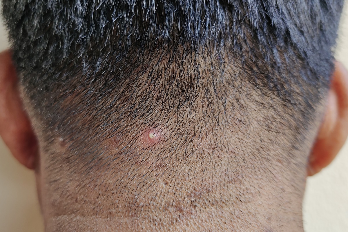 Acne no couro cabeludo: especialista explica como tratar a condição