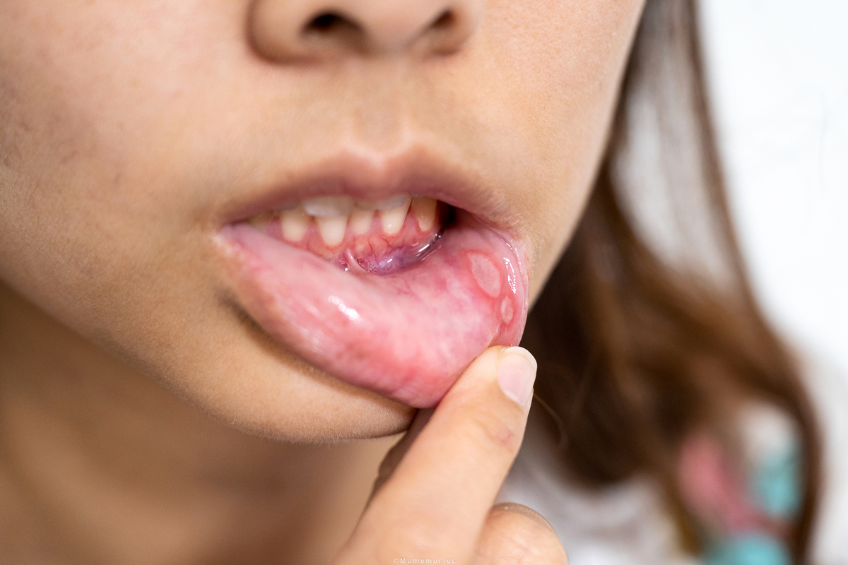 Saiba como tratar aftas de forma caseira e quando procurar o dentista