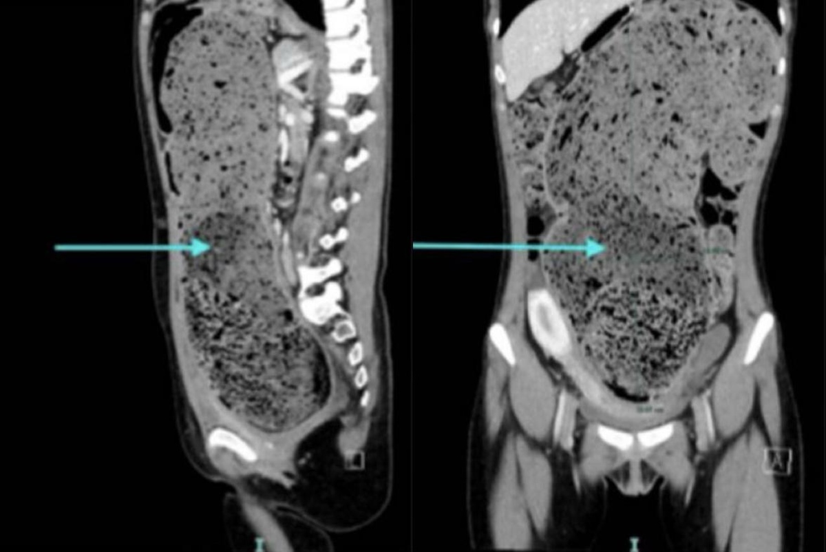 Mulher passa quatro meses constipada e perde 4,5 kg após tratamento