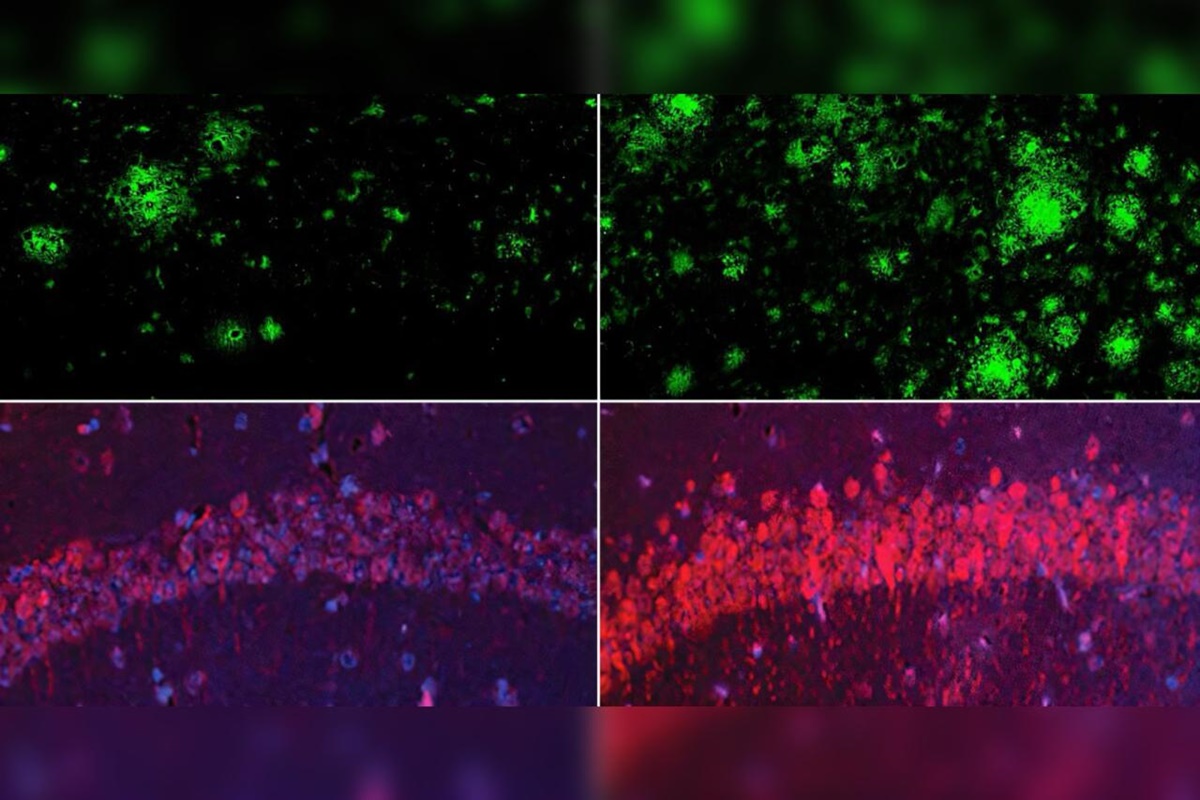 Estudo de Harvard relaciona perda de lítio no cérebro ao Alzheimer