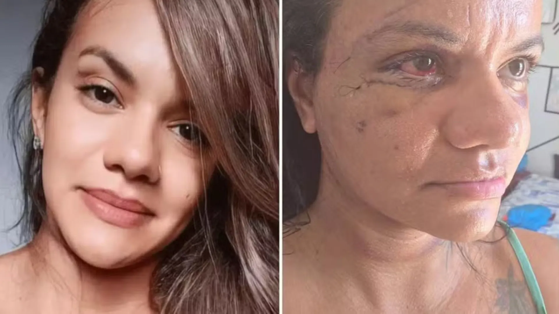 Agredida com 61 socos pelo ex-jogador mostra rosto dias após cirurgia