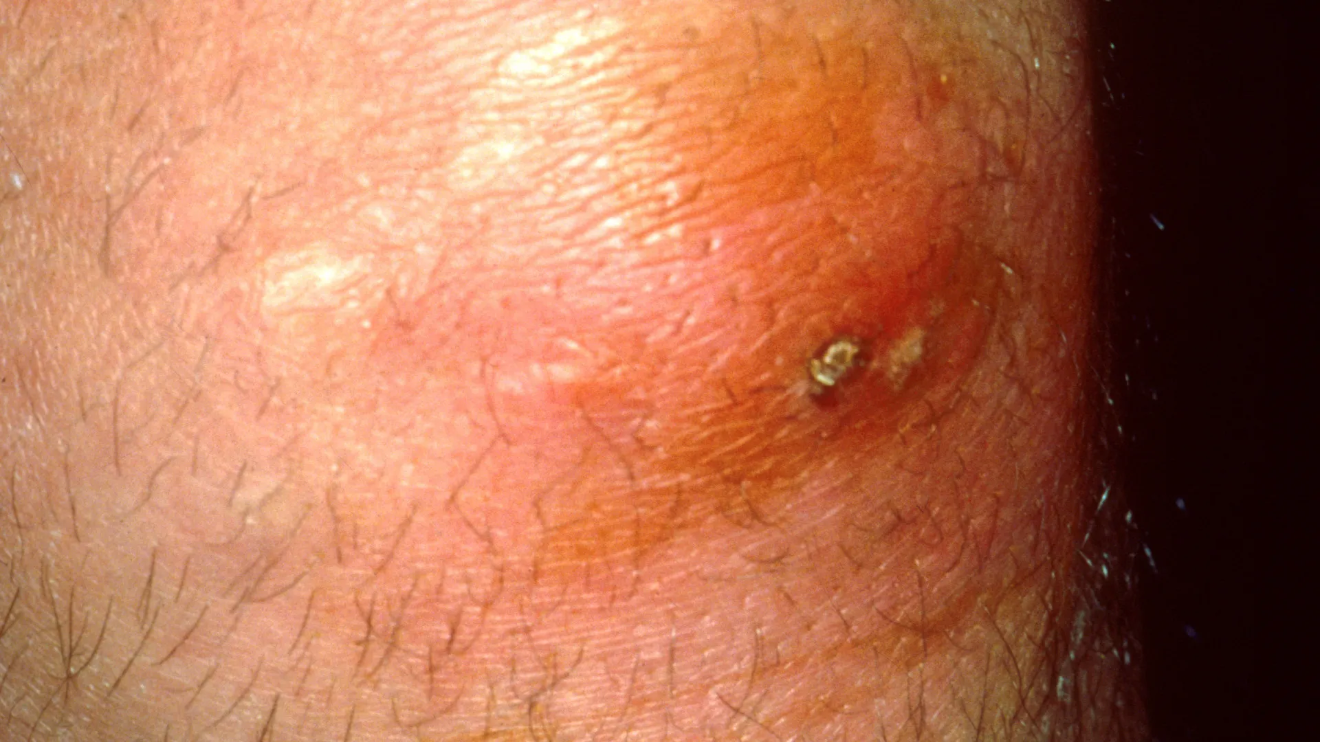Furúnculo pode matar? Dermatologista alerta sobre riscos