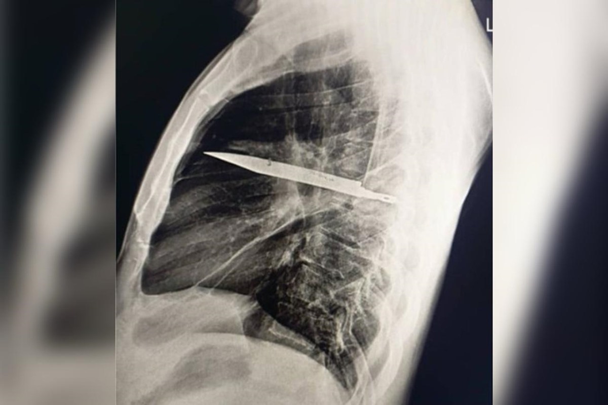 Homem sente dor no peito e descobre faca alojada no corpo há oito anos
