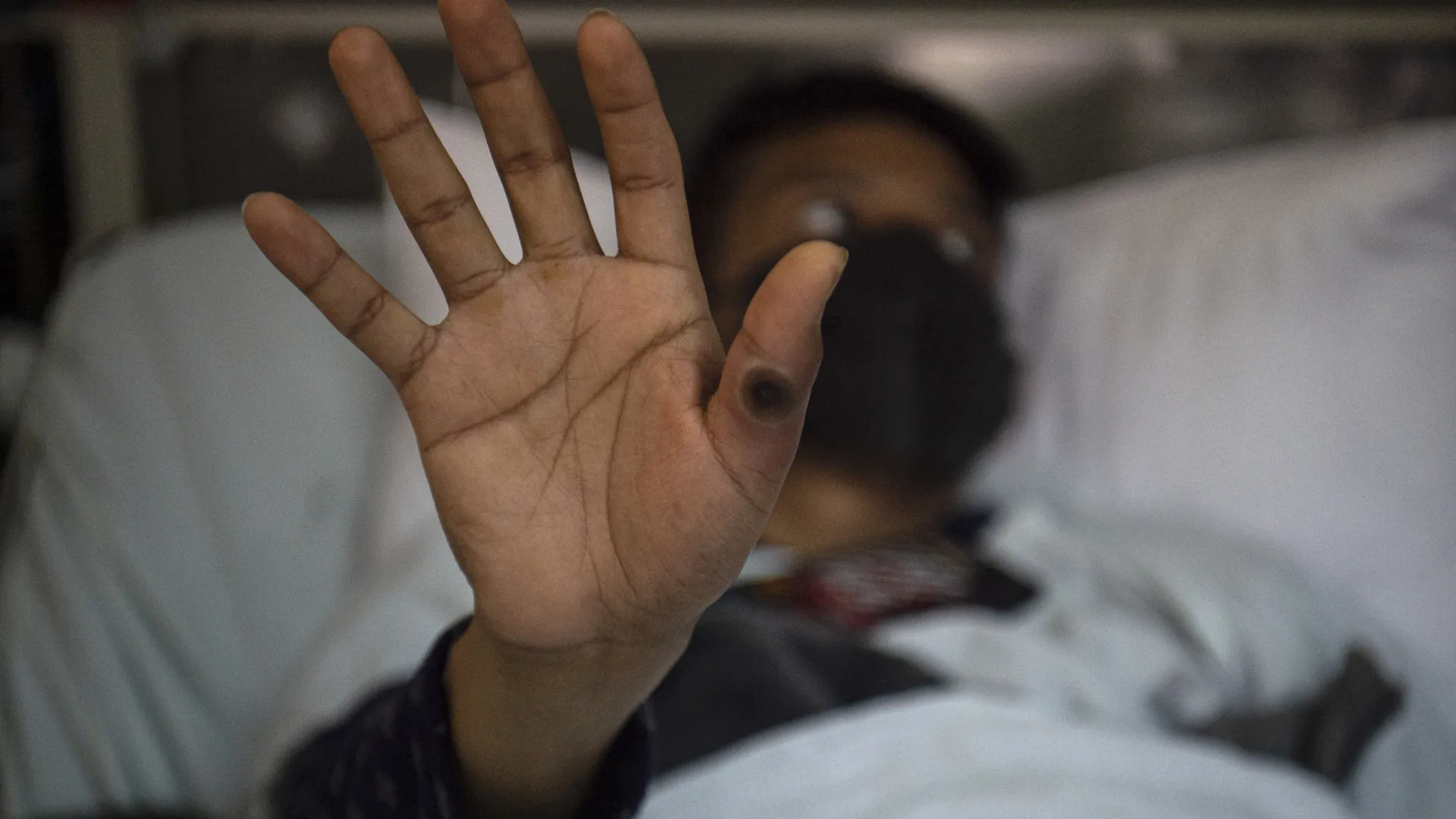 Mpox: África tem quase 50 mil casos confirmados