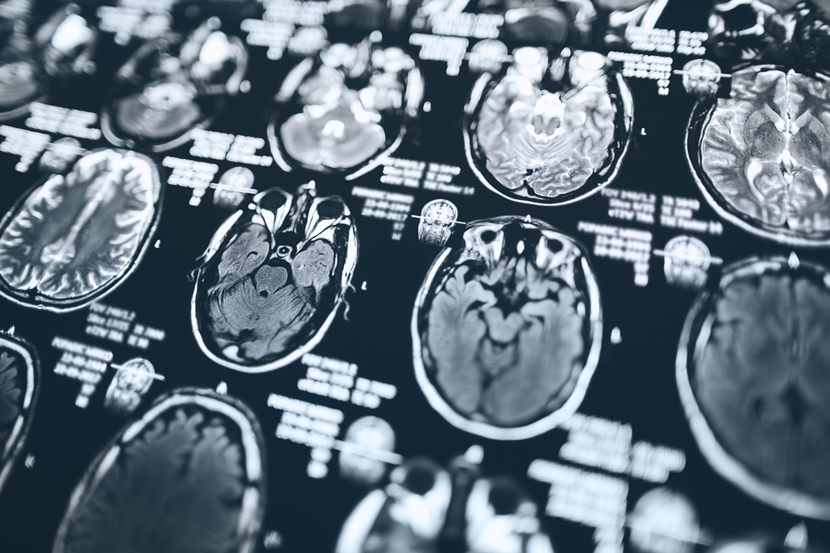 Novo tratamento para Alzheimer chega ao Brasil. Saiba como funciona