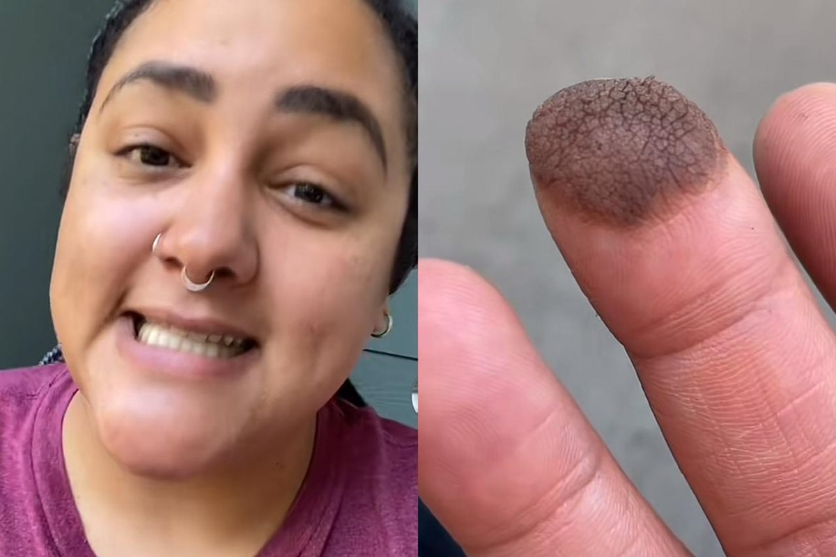 Mulher precisa depilar dedo após fazer enxerto com pele da virilha