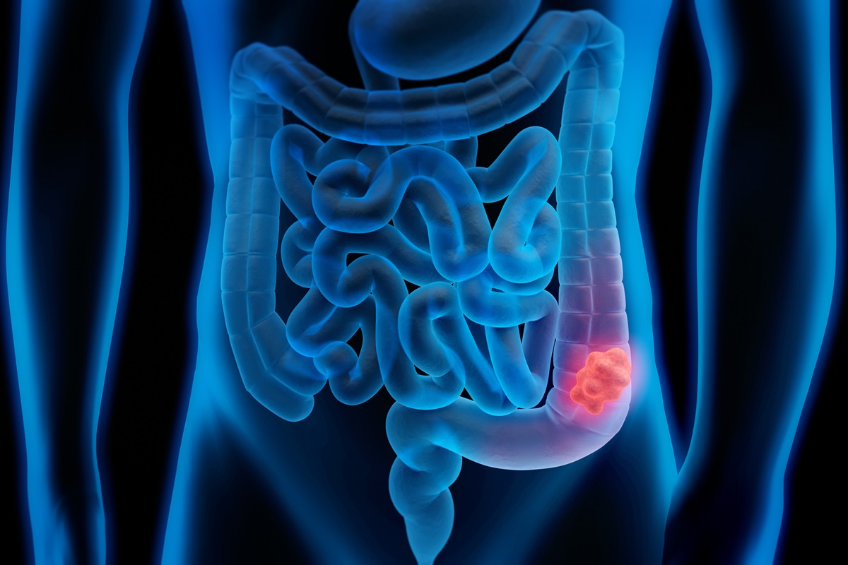 Exame de fezes pode detectar 90% dos cânceres de intestino, diz estudo