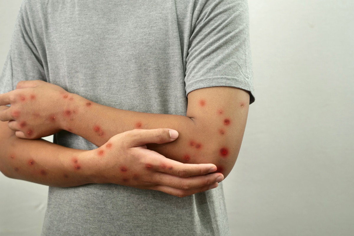 “A mpox não acabou e ainda exige vigilância constante”, diz médica
