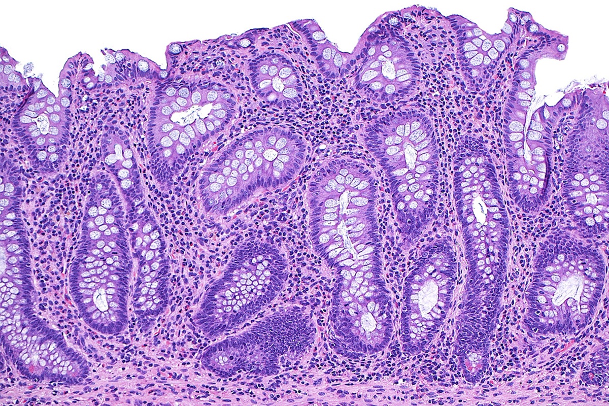 Doenças inflamatórias intestinais não são mais raras e exigem atenção