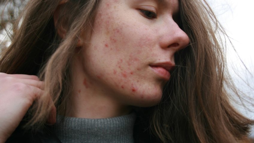 Estudo quer desenvolver vacinas para combater acne; entenda