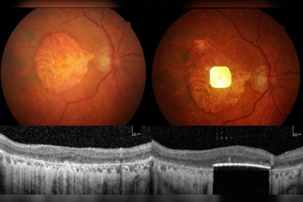 Implante de retina devolve parte da visão a pessoas com cegueira