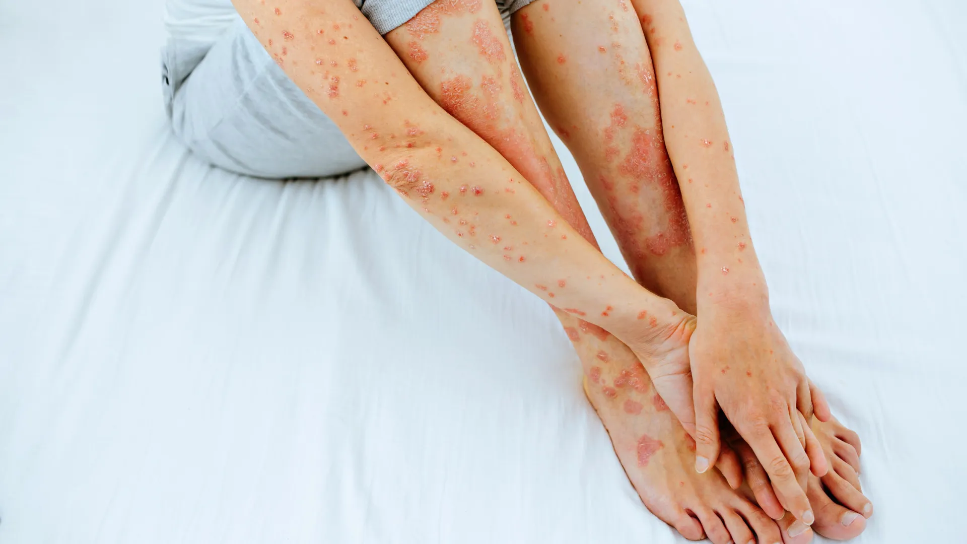 Psoríase: não se pega, mas o estresse pode desencadear