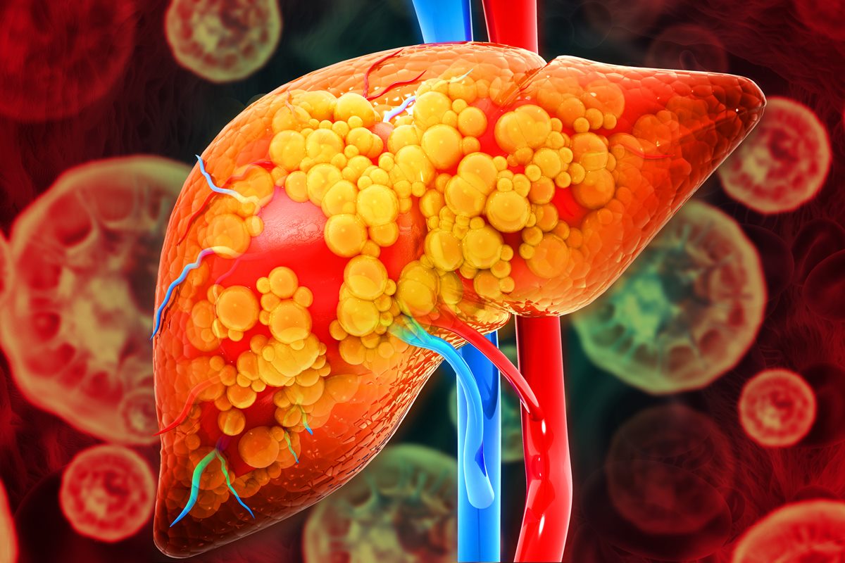 Gordura no fígado: dicas simples para evitar a esteatose hepática