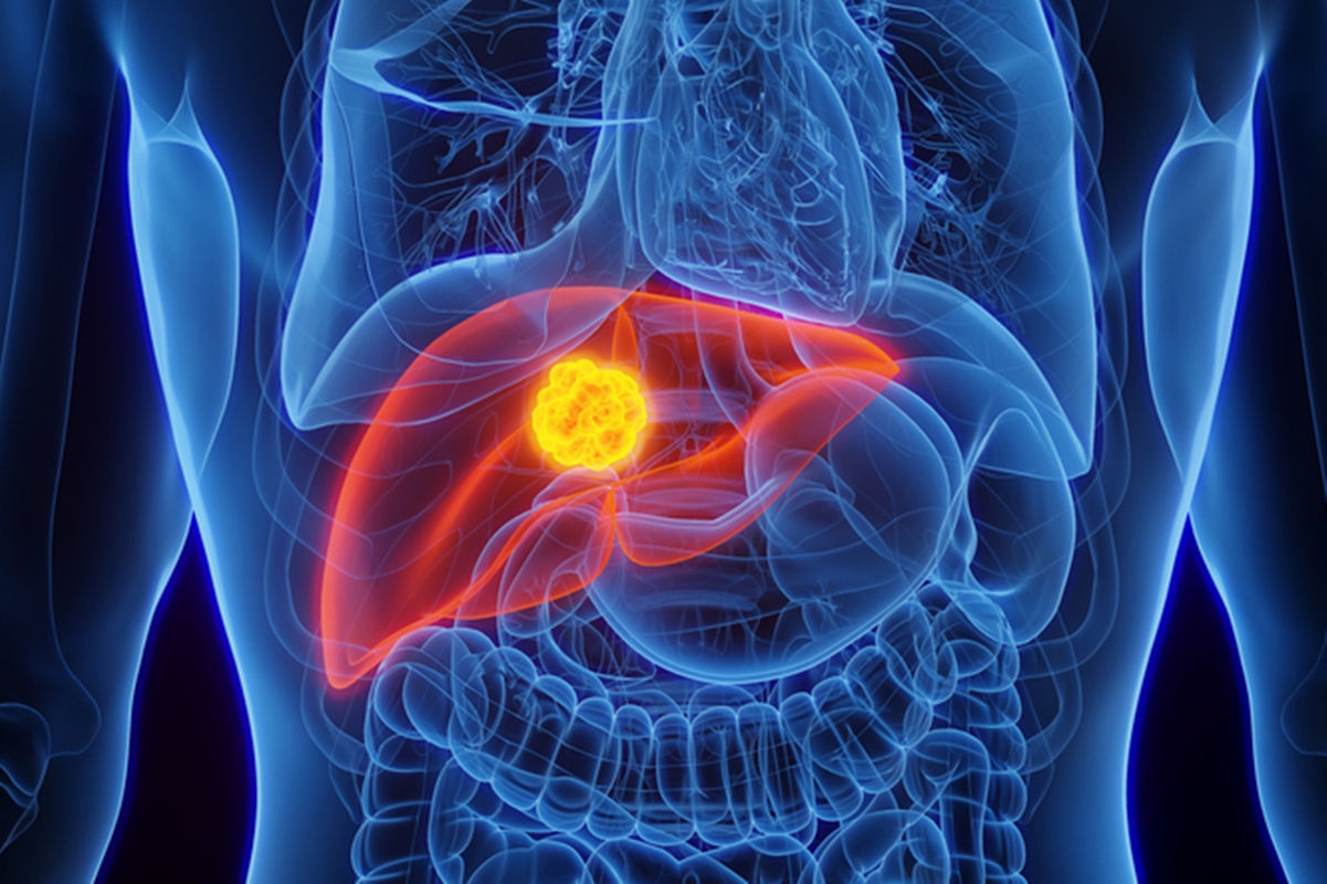 Câncer de fígado: conheça as principais causas e como se prevenir