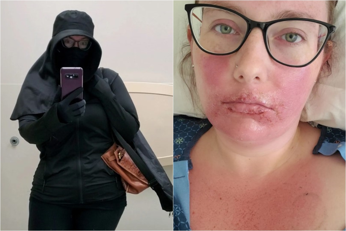 “Tenho que viver como uma vampira”, diz mulher com alergia ao sol