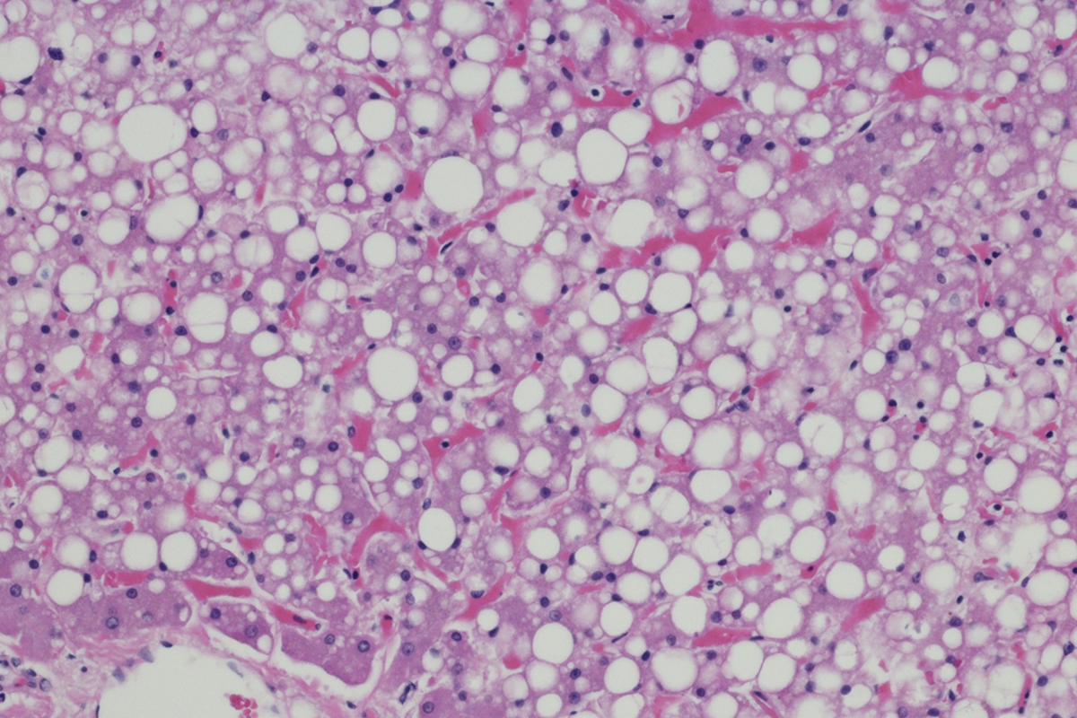 Gordura no fígado: sintomas e como é feito o tratamento da condição