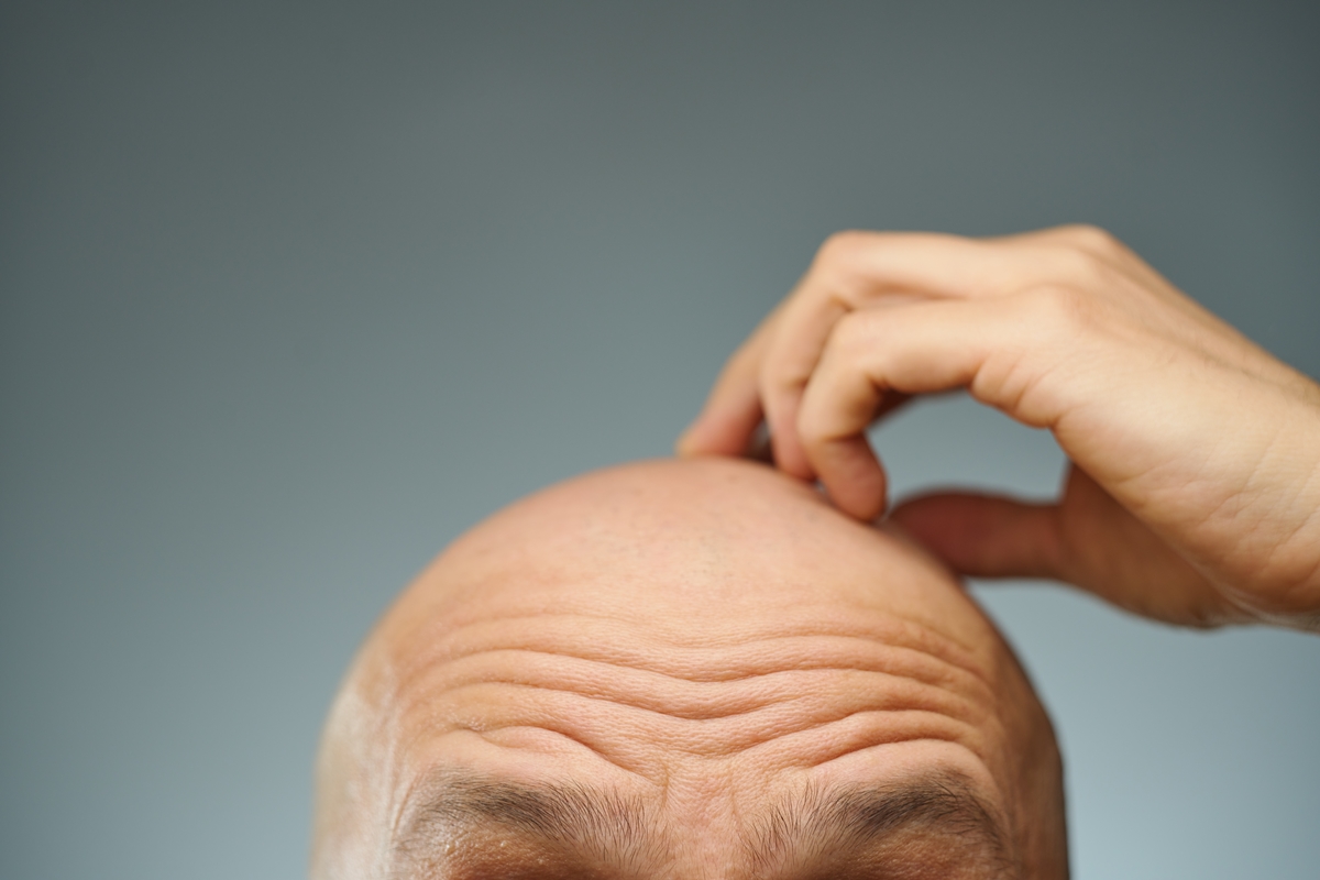 Eles também merecem: saiba como cuidar da pele da cabeça dos carecas