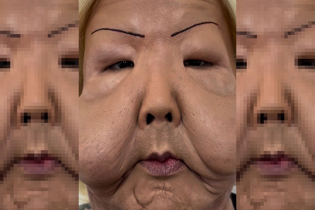 Juju do Pix faz cirurgia após ter rosto deformado em procedimento