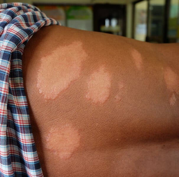 Prefeitura de Cuiabá reforça ações de combate à hanseníase e orienta população a procurar USFs ao identificar sintomas