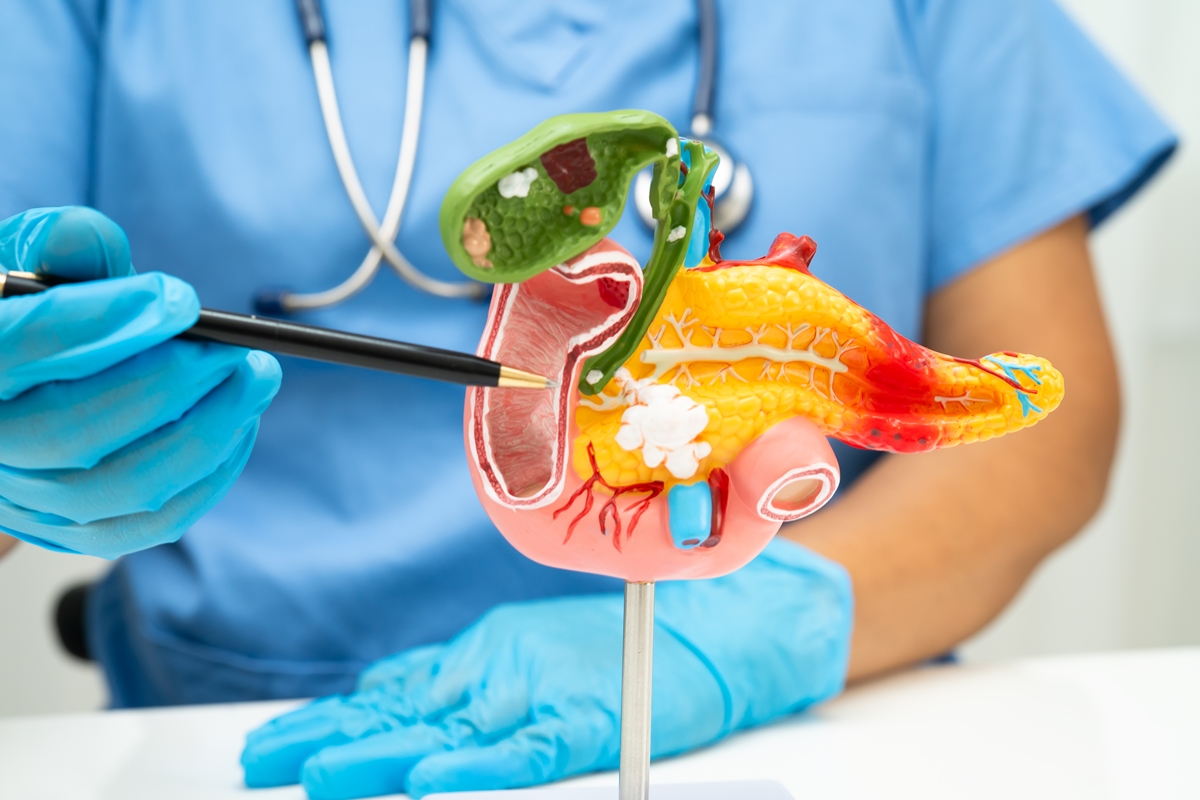 Diabetes repentina após os 50 anos pode sinalizar câncer de pâncreas