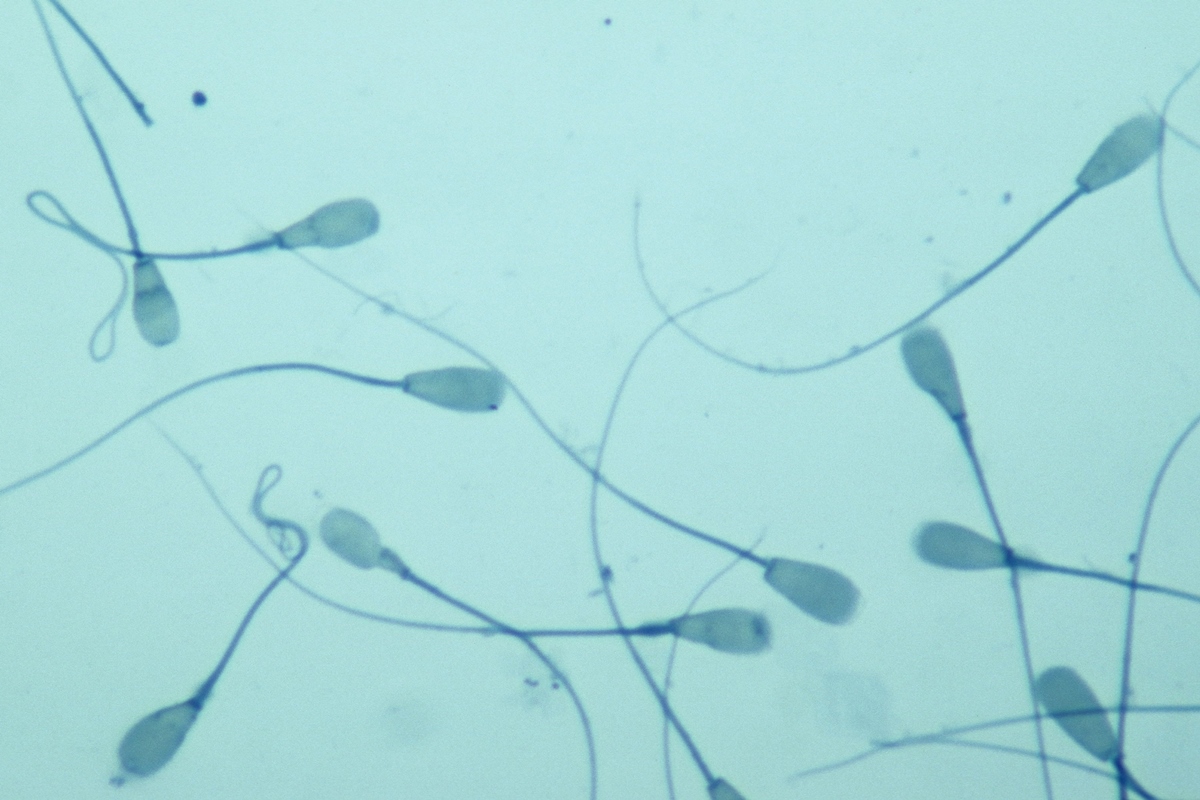 Esperma com mutação ligada ao câncer gerou 197 crianças na Europa