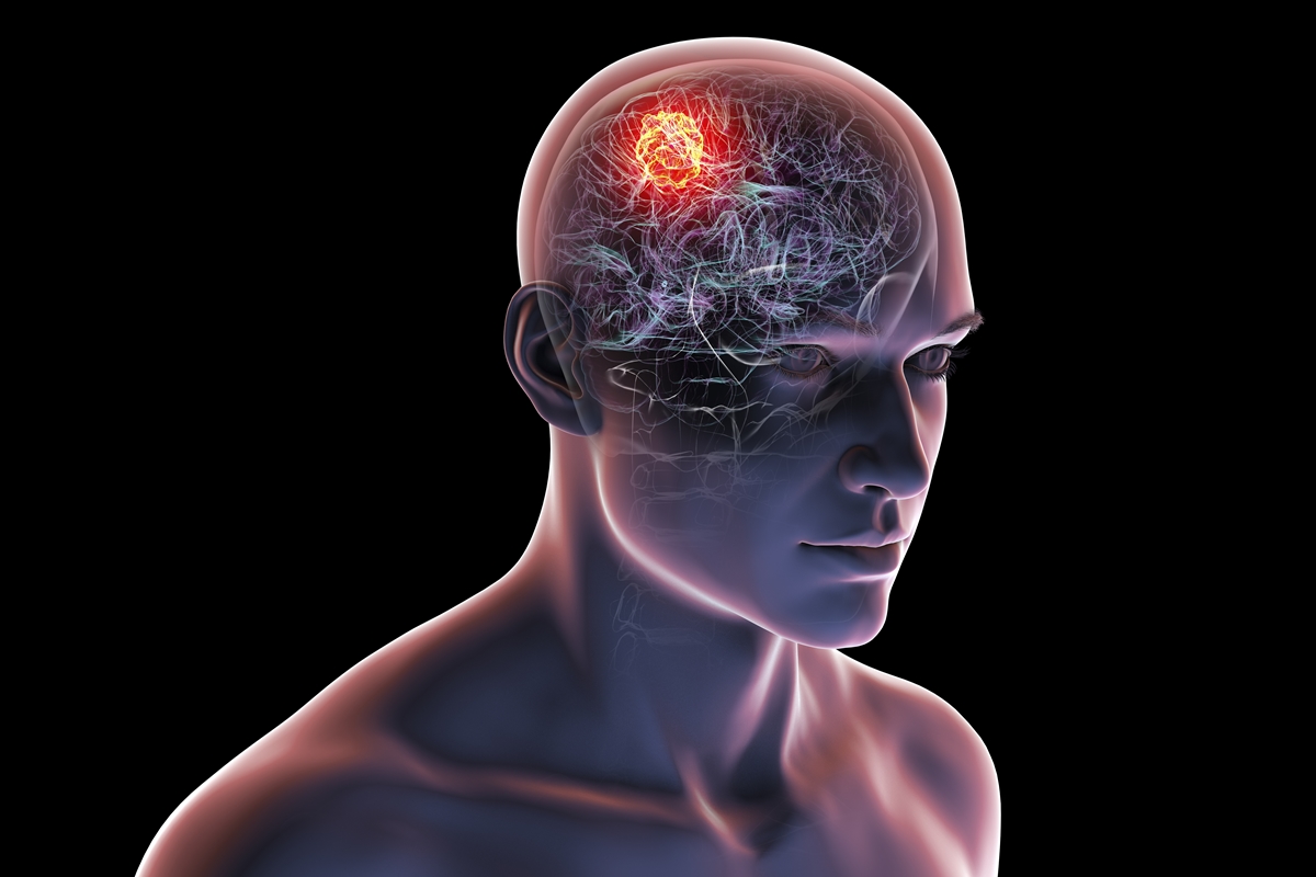 Combinação de suplementos reduz efeitos de tumor cerebral agressivo