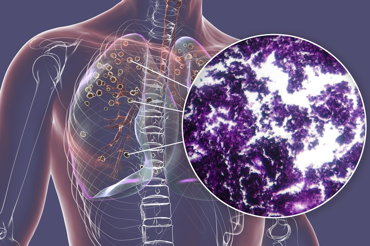 Exame de sangue pode antecipar diagnóstico do câncer de pulmão