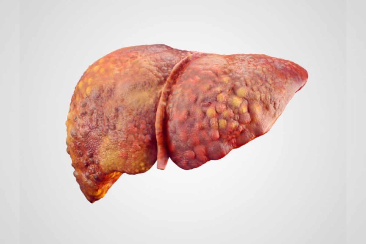 Gordura no fígado: estudo explica desenvolvimento em pessoas magras