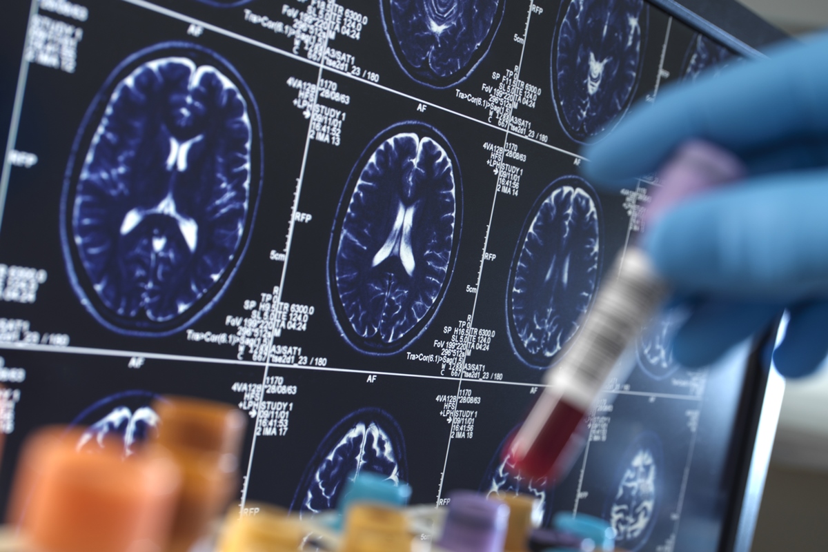 “Biópsia” do cérebro detecta Alzheimer antes de sintomas, diz estudo