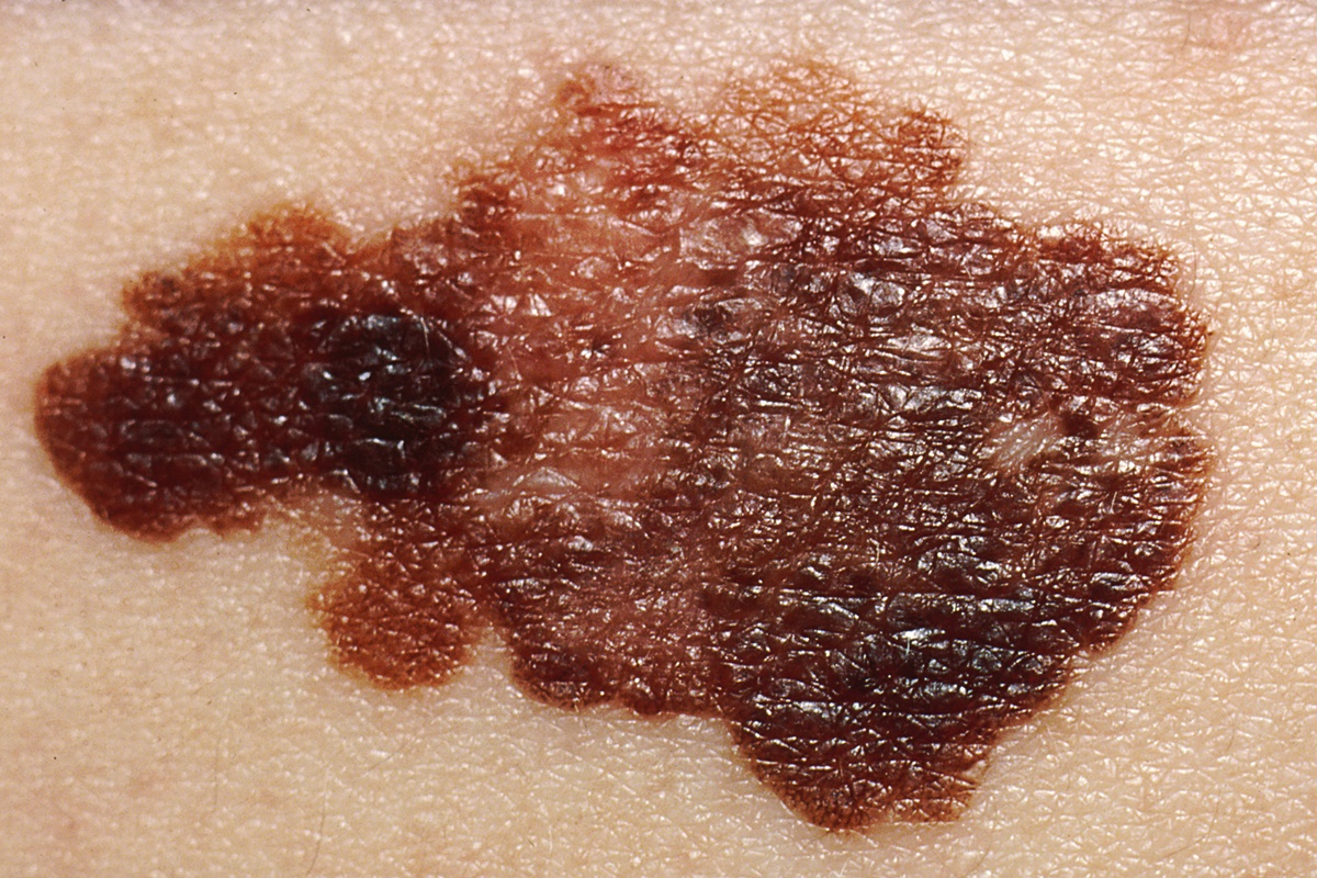 Câncer de pele: dermatologista diz como identificar sinais suspeitos