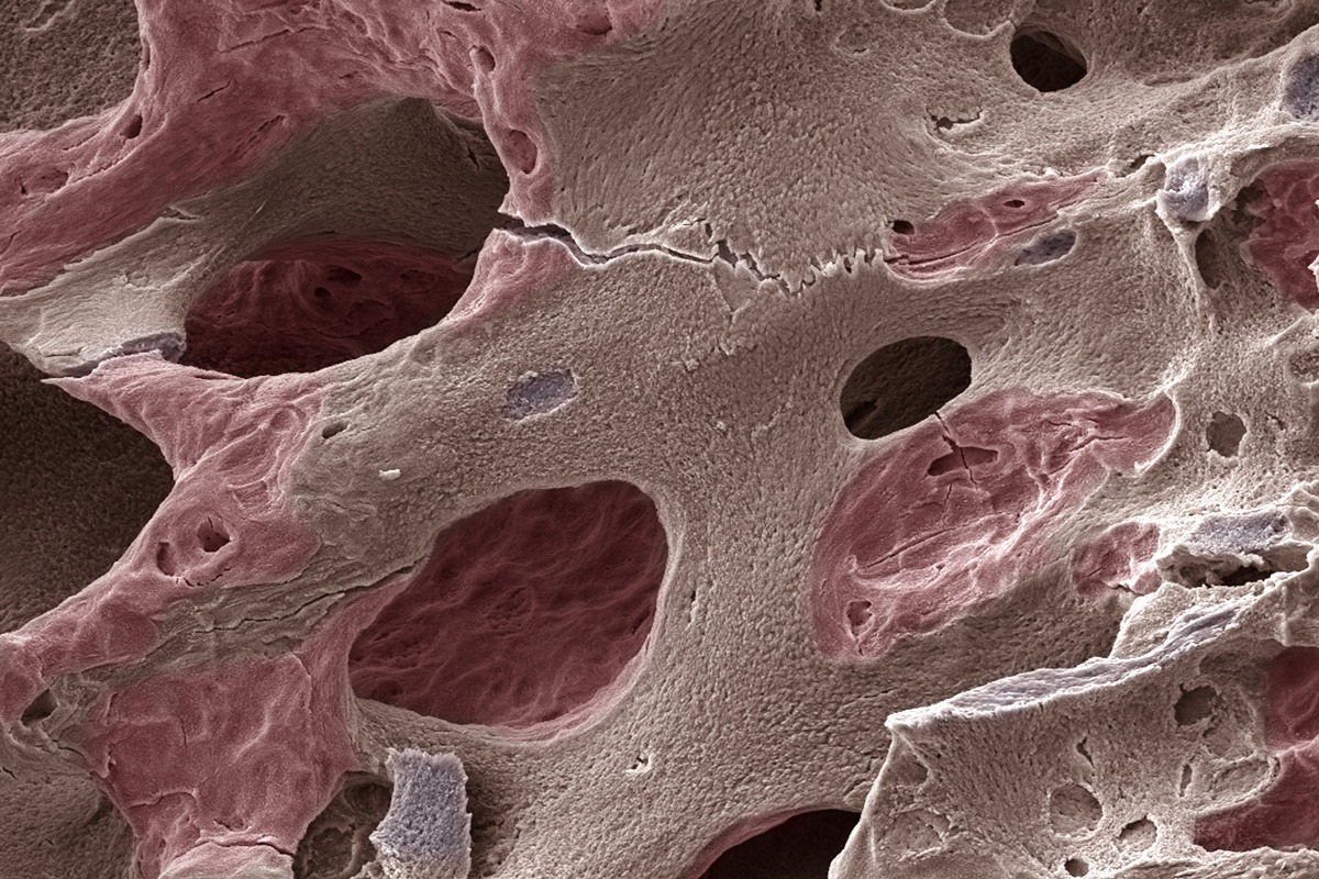 Casos de osteoporose devem disparar até 2050, inclusive no Brasil