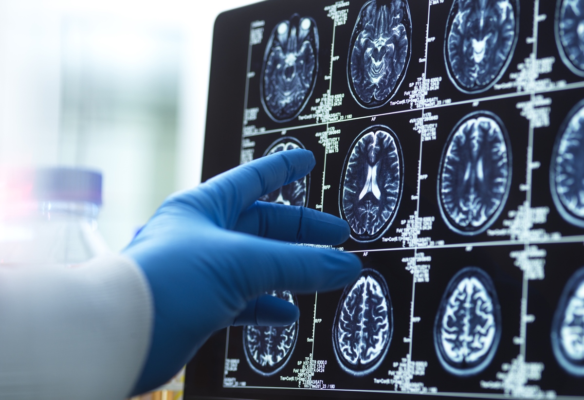 Estudo encontra sinal inédito do Alzheimer em exame de imagem comum