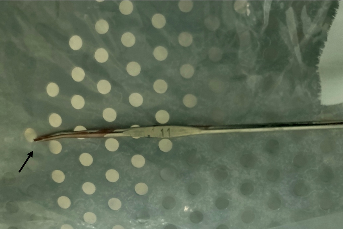 Menino senta em agulha de crochê e gancho torna cirurgia um desafio