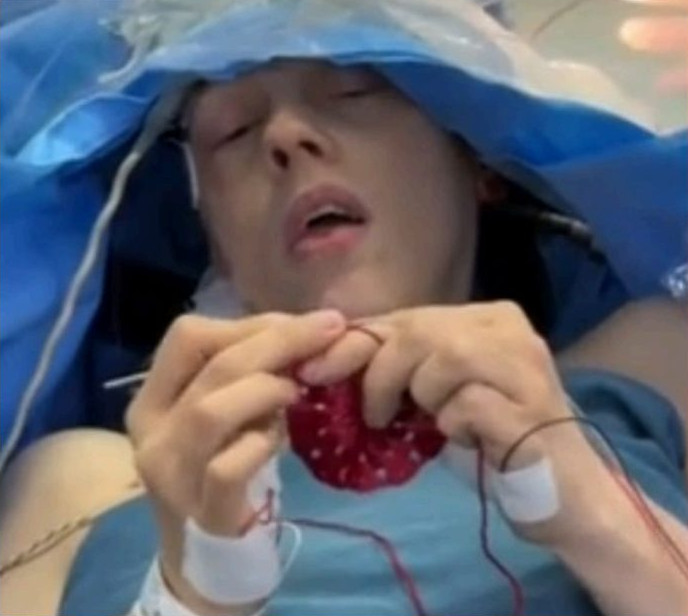 Durante cirurgia no cérebro, agricultora faz crochê enquanto médicos retiram tumor