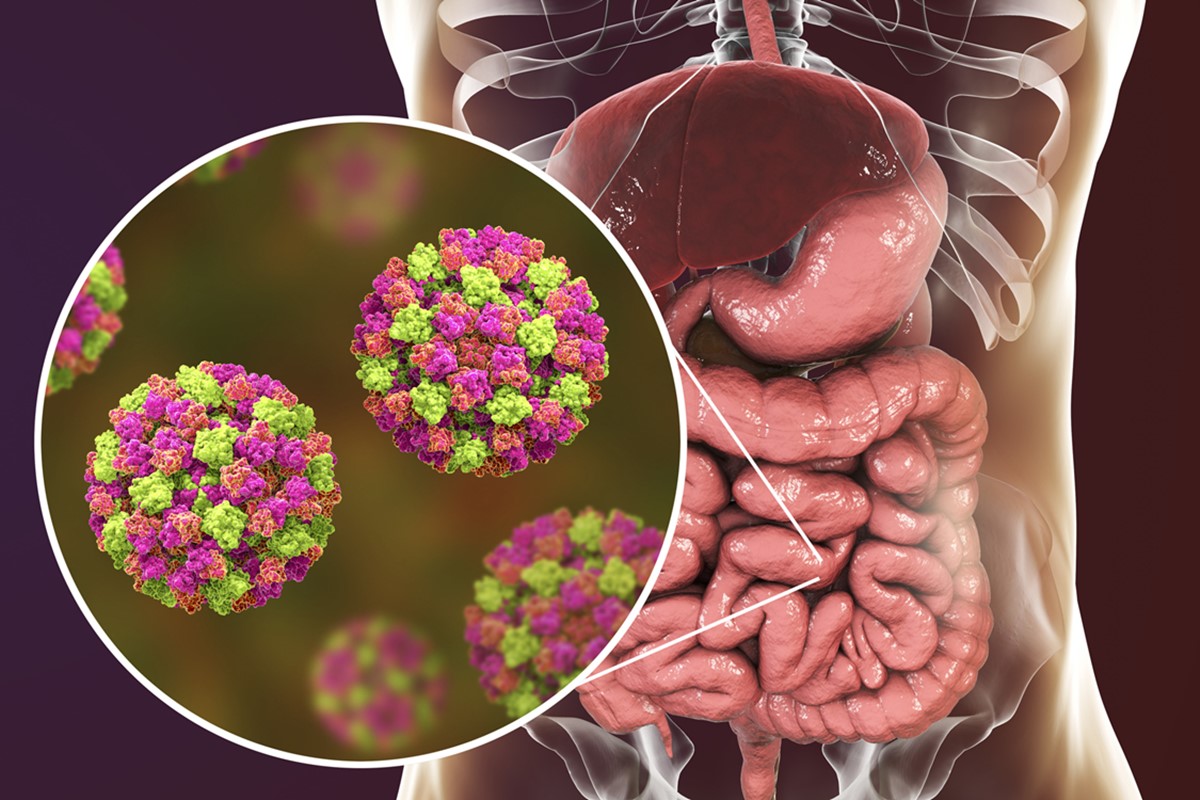 Norovírus: vacina oral apresenta bons resultados em testes iniciais